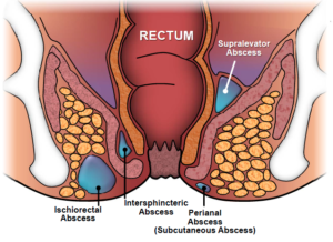 Read more about the article BEST MEDICINE FOR ANAL FISTULA