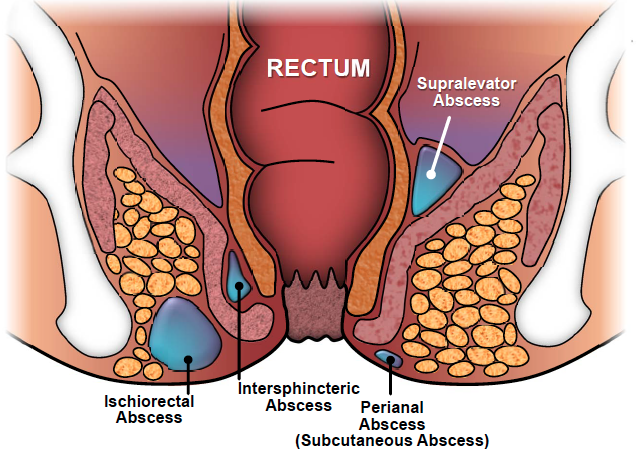 You are currently viewing BEST MEDICINE FOR ANAL FISTULA