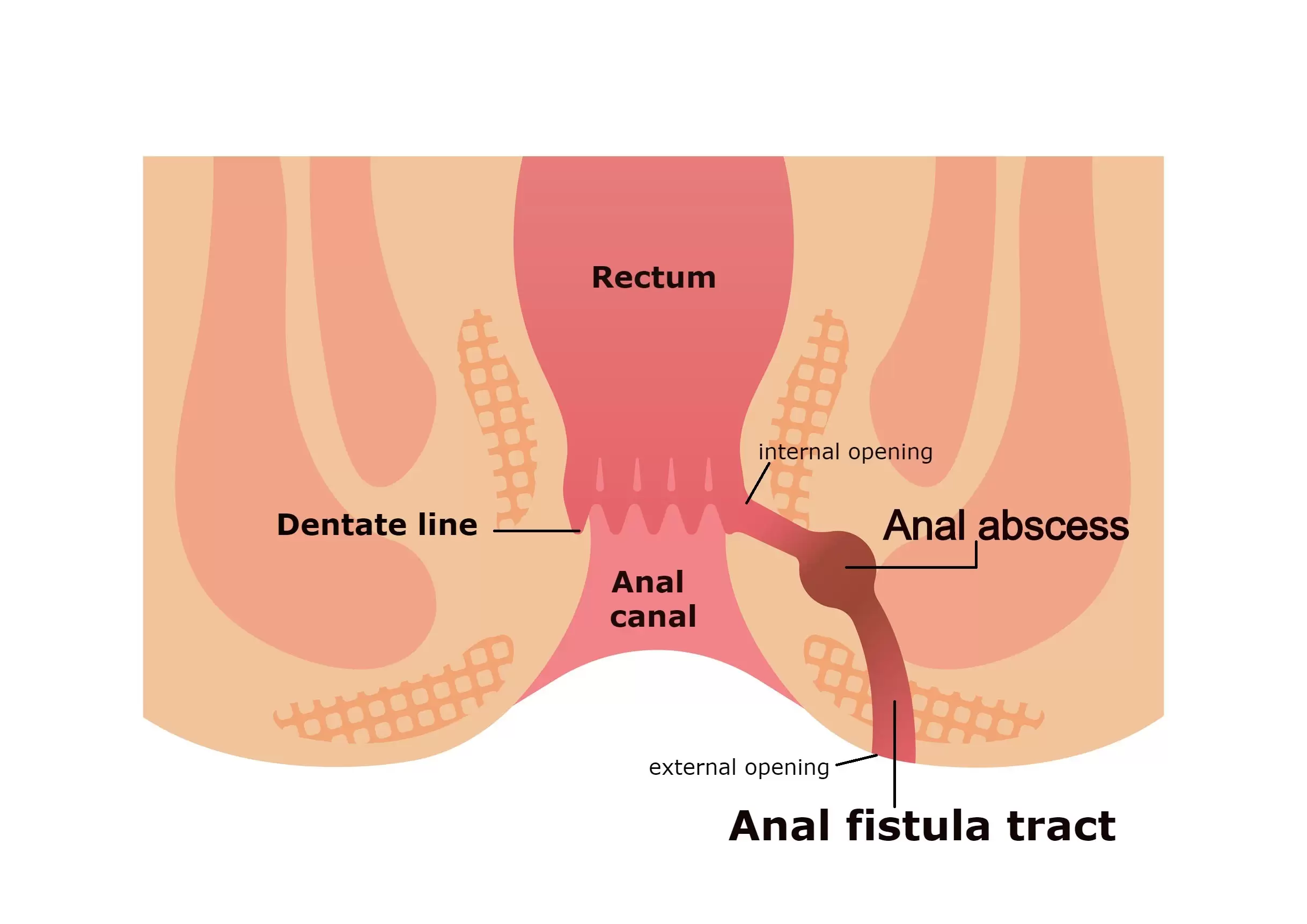 Read more about the article 10 Tips for Using Homeopathy in Fistula Treatment