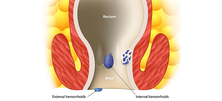 Piles Treatment