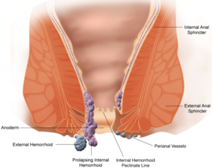 Read more about the article 7 Effective Homeopathic Remedies for Fistula Relief