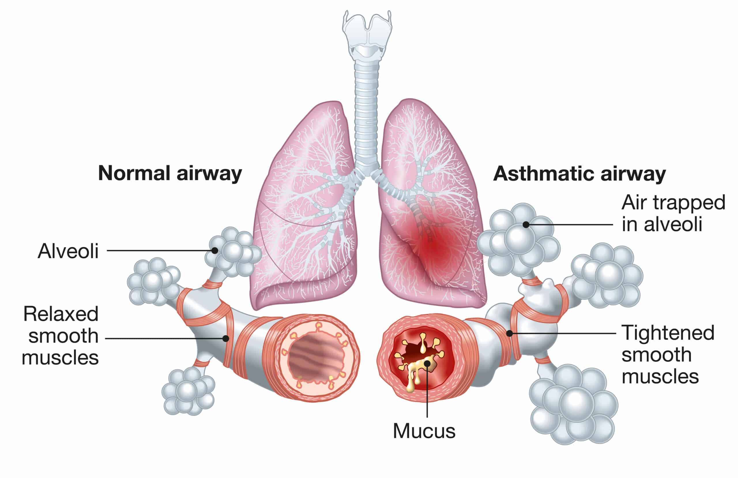 Read more about the article What Are the Benefits of Homeopathy for Asthma Patients?