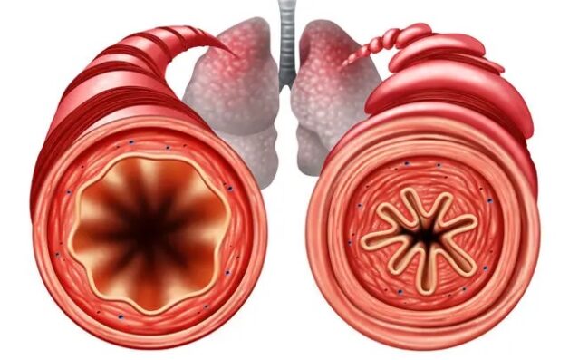 You are currently viewing WHAT IS THE PERMANENT TREATMENT FOR ASTHMA?