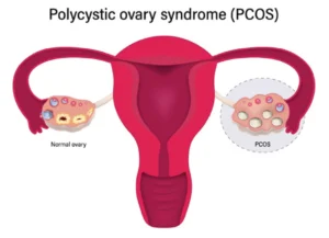 Read more about the article How to Find a Homeopath for PCOS Treatment?