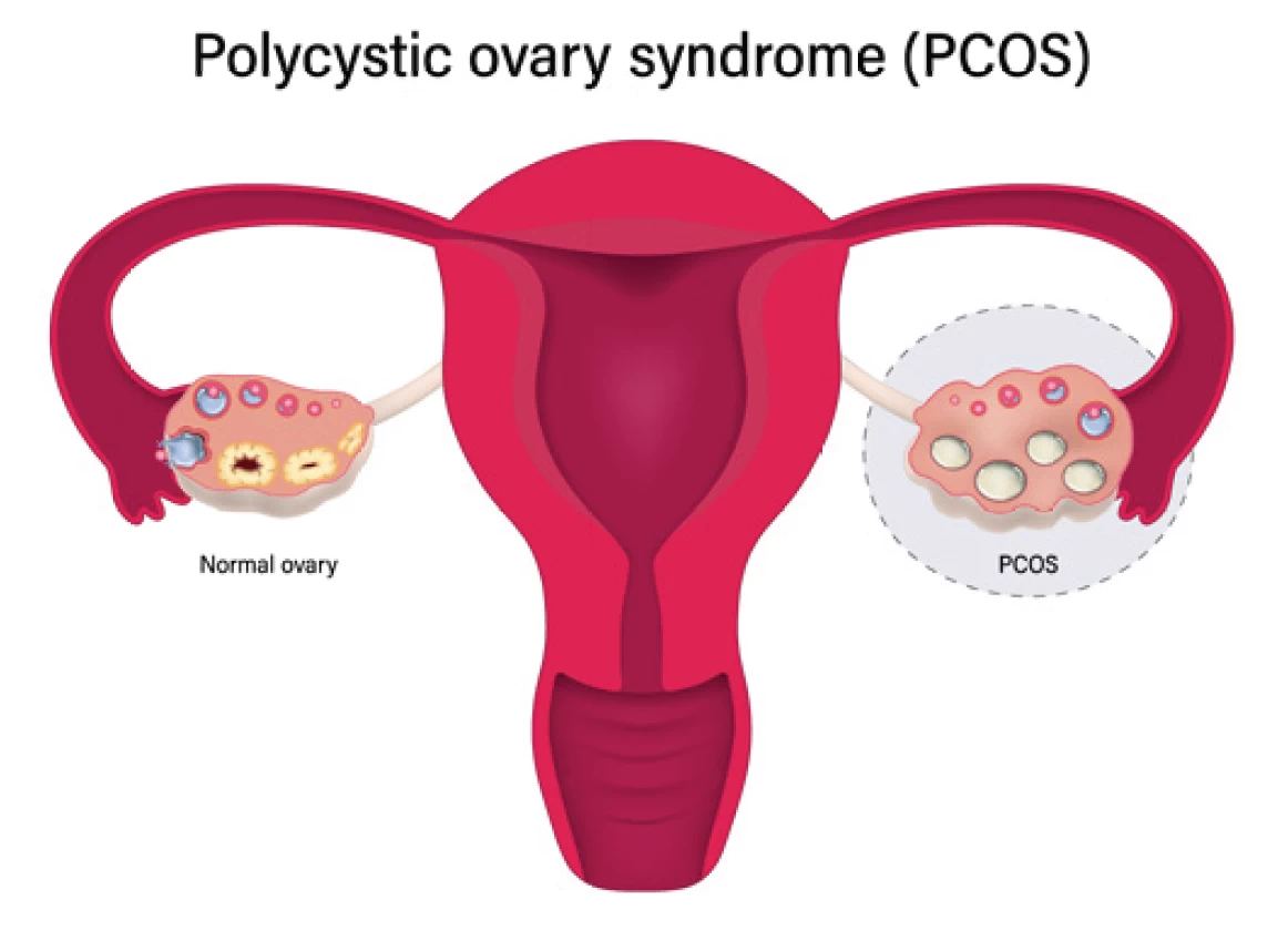 You are currently viewing How to Find a Homeopath for PCOS Treatment?