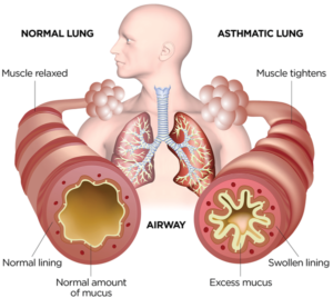 Read more about the article How to Use Homeopathy for Asthma Relief ?