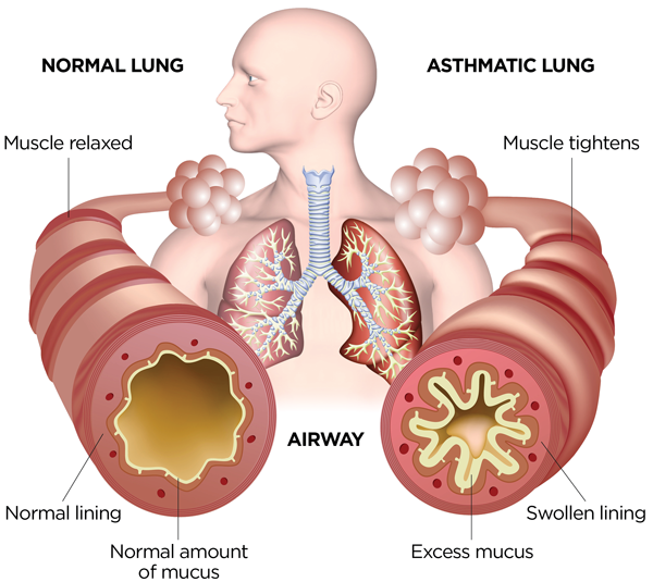 Asthma Relief