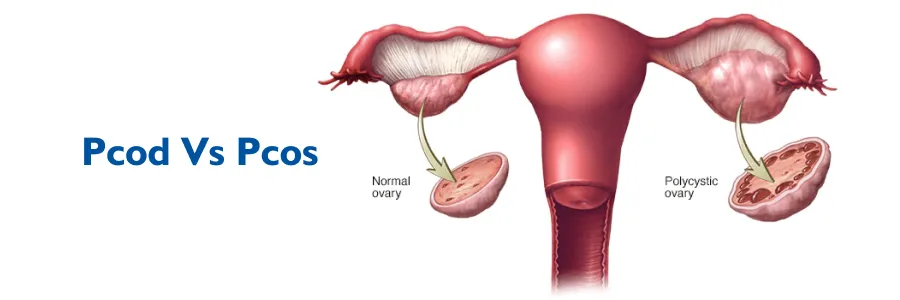 Read more about the article PCOD vs PCOS: What’s the Difference & How Homeopathy Treats Both