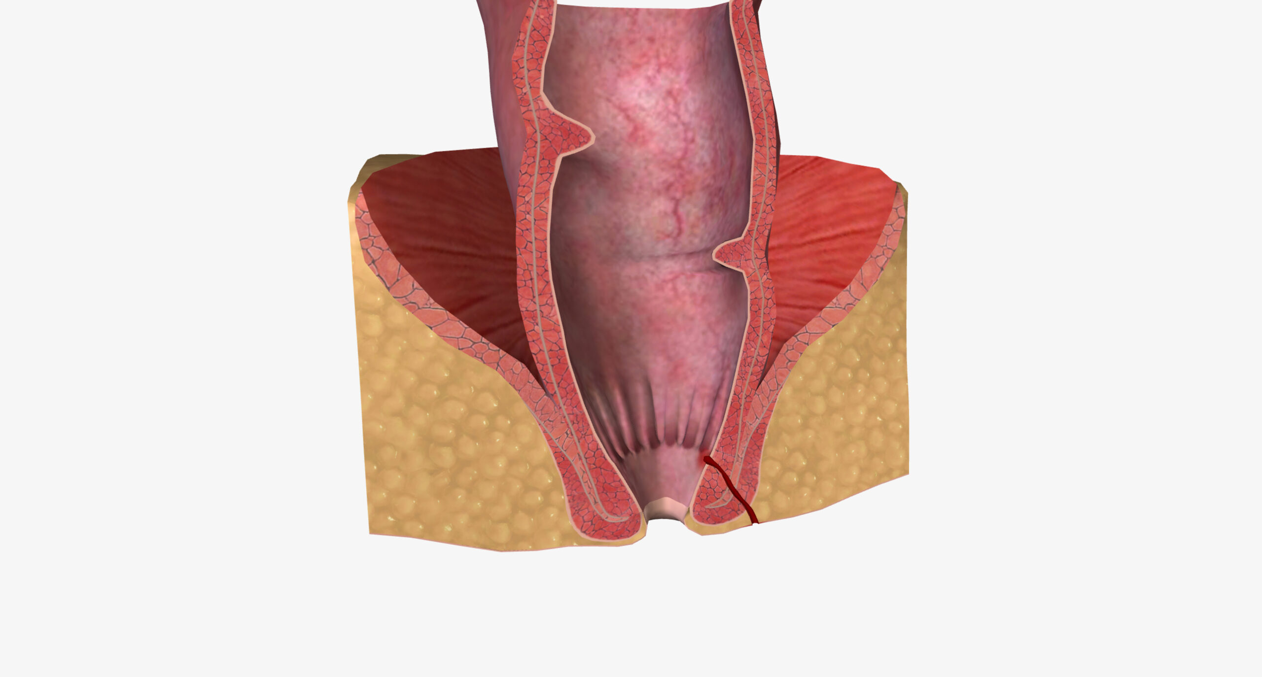 Read more about the article Fistula Treatment in Homeopathy: A Natural Approach to Healing Perianal Fistula