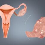 Symptoms of PCOS? Take This Quiz Before You Visit a Doctor