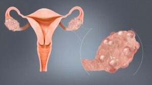 Read more about the article Symptoms of PCOS? Take This Quiz Before You Visit a Doctor