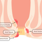 What is Anal Fistula? Causes, Symptoms, and Diagnosis
