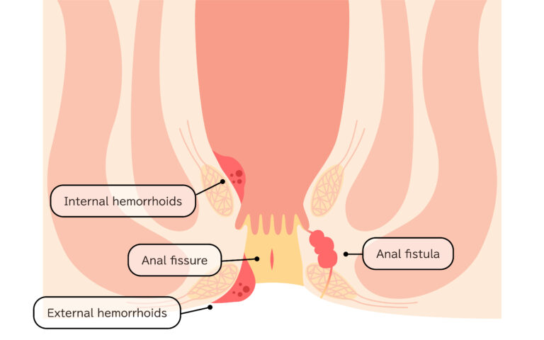 Anal Fistula