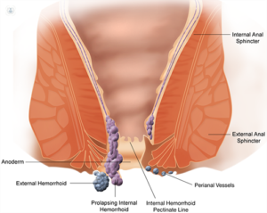Read more about the article Difference Between Piles , Fistulaa and Fissure