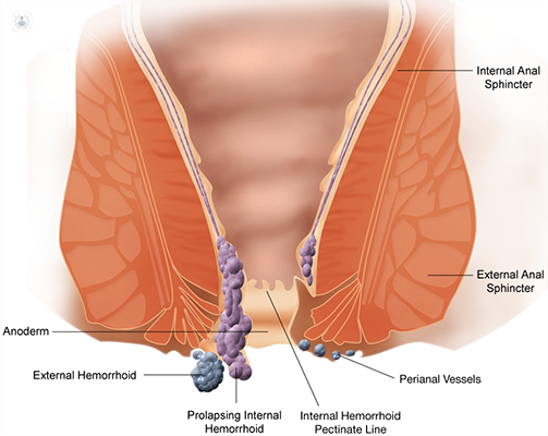 Read more about the article Difference Between Piles , Fistulaa and Fissure