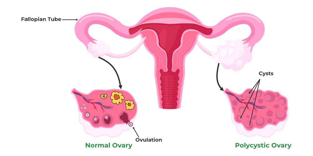 Read more about the article Why Hormonal Imbalance Causes PCOD and How Homeopathy Addresses It