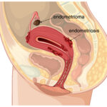 Top 5 Natural Remedies for Fistula Relief