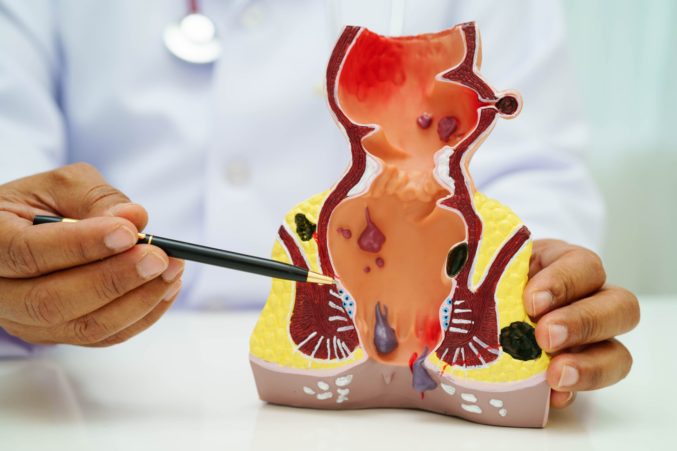 Read more about the article Best Treatment for Piles and Fissure: Homeopathy vs Surgery