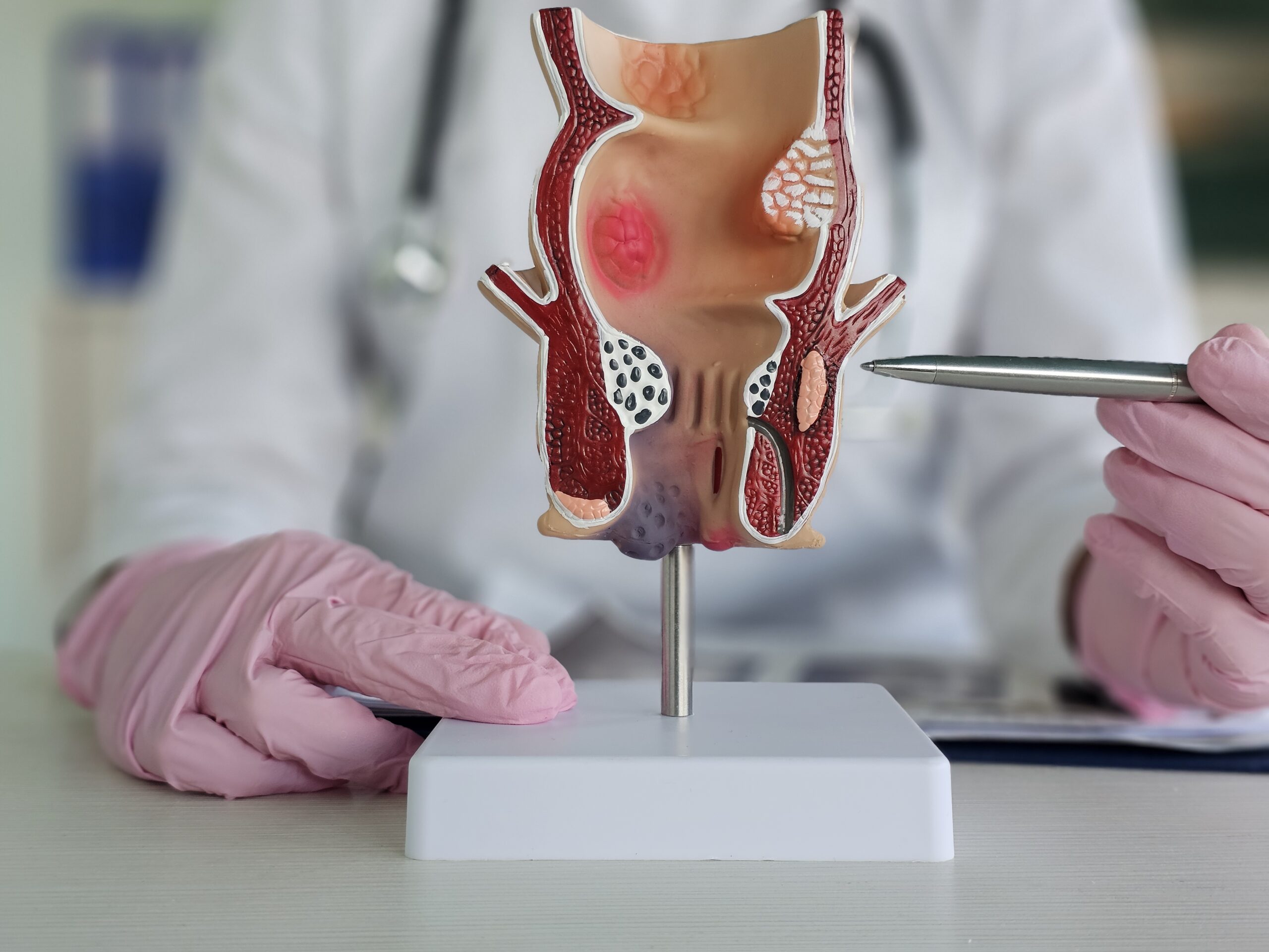 You are currently viewing Homeopathic Treatment for Anal Fistula: How It Works