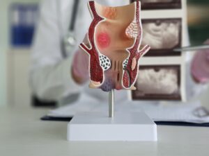 Read more about the article Best Treatment for Piles in Homeopathy: Safe and Effective Solutions