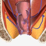 Why You Should Avoid Surgery for Fistula and Try Homeopathy First ?