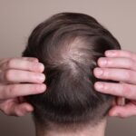 Alopecia Areata is a Common Type of Hair Loss