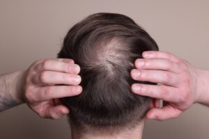 Read more about the article Alopecia Areata is a Common Type of Hair Loss