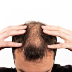 How to Stop Alopecia Areata from Spreading