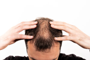 Read more about the article How to Stop Alopecia Areata from Spreading