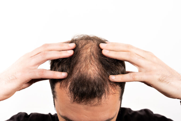 Alopecia Areata