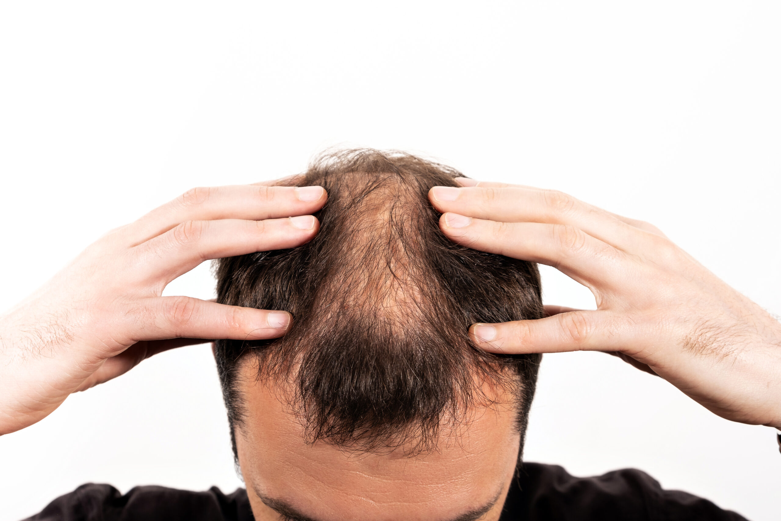 You are currently viewing How to Stop Alopecia Areata from Spreading