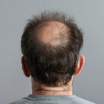 Hair Loss Types: Alopecia Areata Diagnosis and T/T