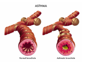 Read more about the article How to Treat an Asthma Attack Without an Inhaler