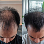 Alopecia Areata vs Androgenic Alopecia: What’s the Difference?