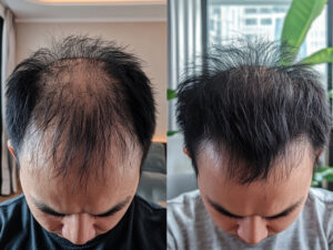 Read more about the article Alopecia Areata vs Androgenic Alopecia: What’s the Difference?