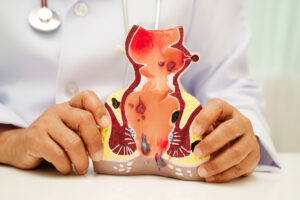 Read more about the article Why Repeated Antibiotics Can Delay Healing in Fistula Patients ?