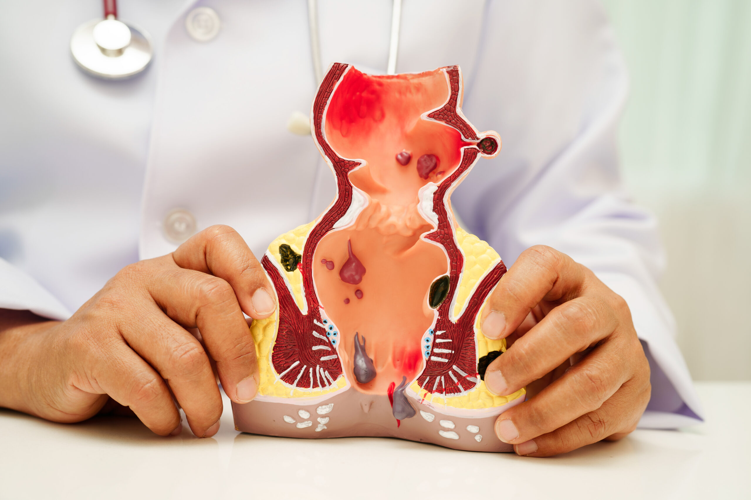 You are currently viewing Why Repeated Antibiotics Can Delay Healing in Fistula Patients ?