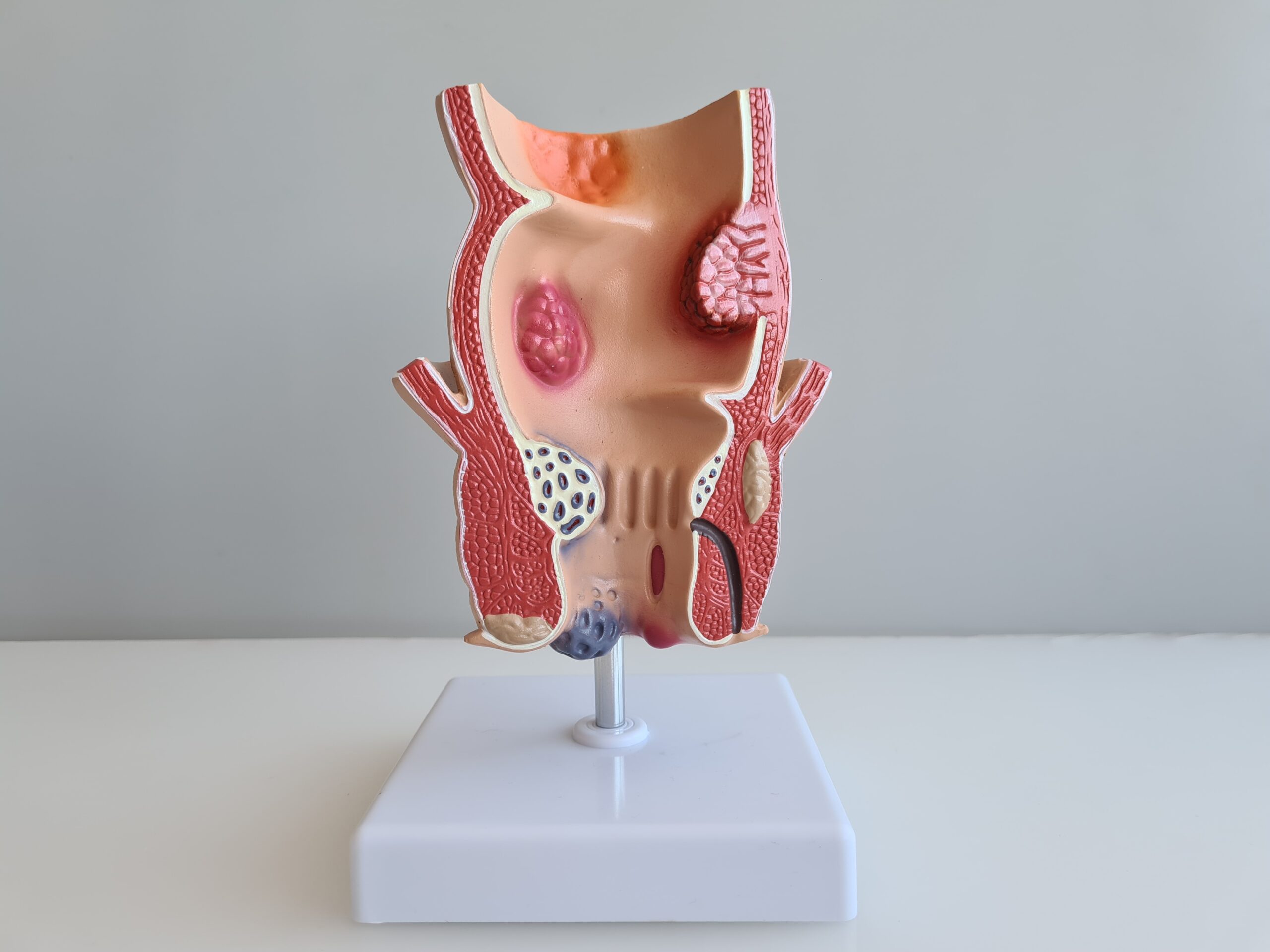 You are currently viewing Best Homoeopathic Medicines for Fistula Treatment