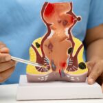 Best Piles Treatment in Delhi for Internal and External Hemorrhoids