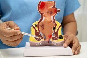 Read more about the article Best Piles Treatment in Delhi for Internal and External Hemorrhoids