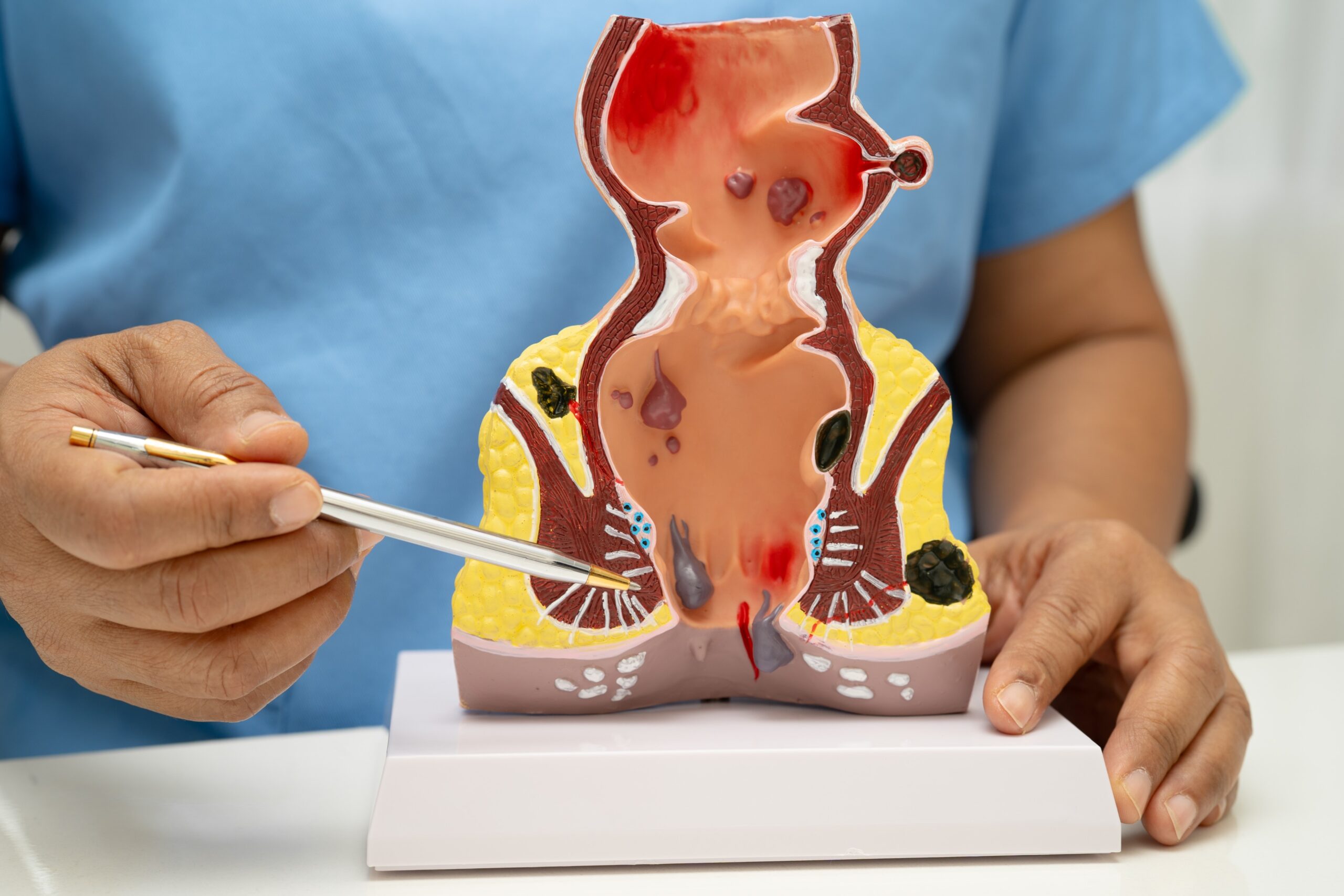 You are currently viewing Best Piles Treatment in Delhi for Internal and External Hemorrhoids