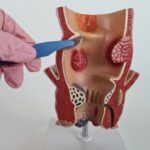 Best Homoeopathy Doctor for Piles: Expert Advice and Remedies