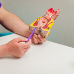 Complete Guide to Fistula Treatment in Homoeopathy