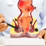 Homoeopathy vs Surgery for Fistula: Which Treatment Works Better?
