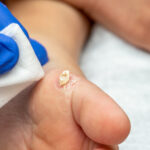What Causes Plantar Warts? Symptoms, Risk Factors & Treatment Explained ?