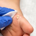 Plantar Warts vs Corn: Difference, Pictures and Homoeopathic Treatment