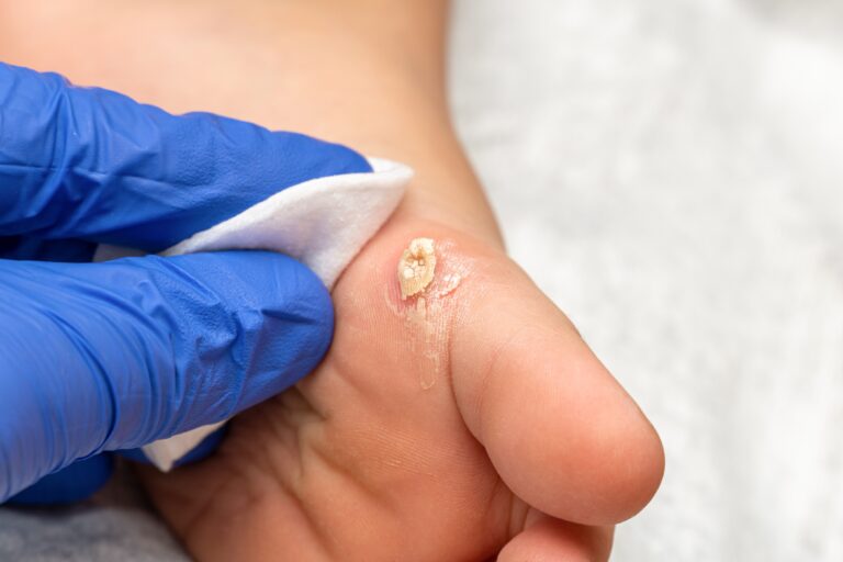 Plantar Warts