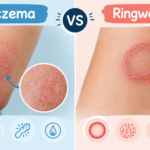 Eczema vs Ringworm: How to Tell the Difference