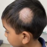 Alopecia areata in Children: When should parents consult a hairloss doctor?