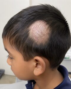 Read more about the article Alopecia areata in Children: When should parents consult a hairloss doctor?